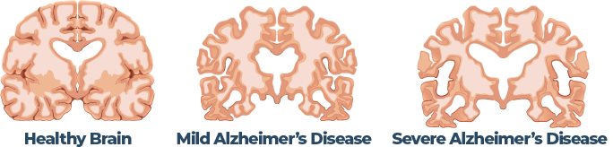 Progression Of Alzheimers Disease