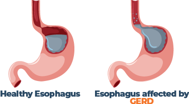 Healthy Vs Esophagus Affected By GERD Illustration