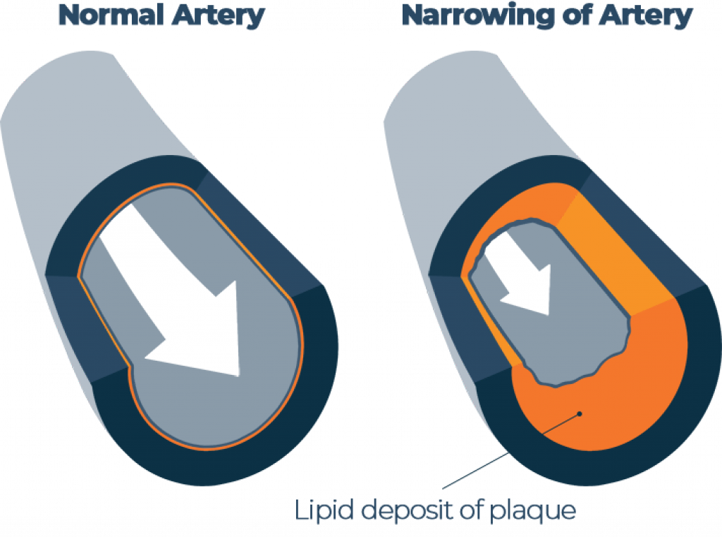 Illustration of Coronary Artery Disease