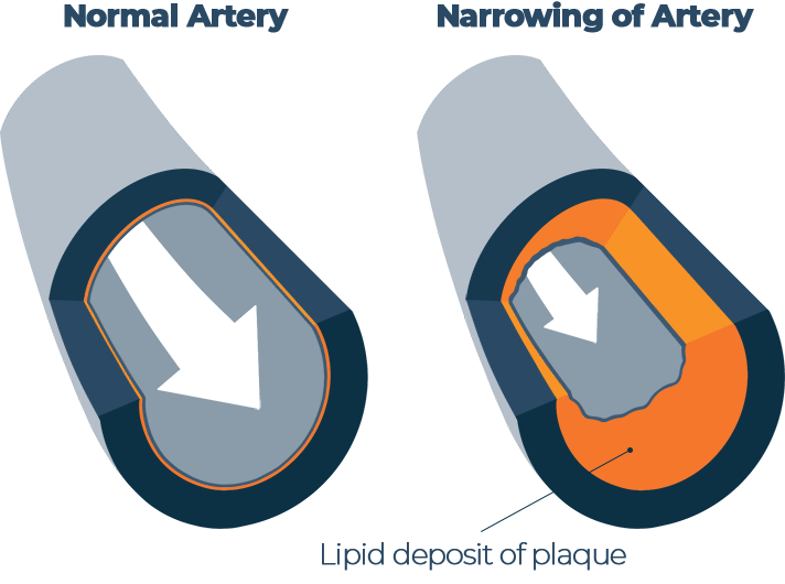 Illustration of Coronary Artery Disease