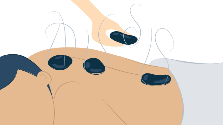 Illustration of Hot Rocks Treatment