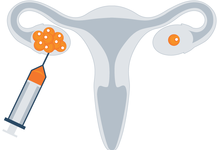 Illustration of IVF