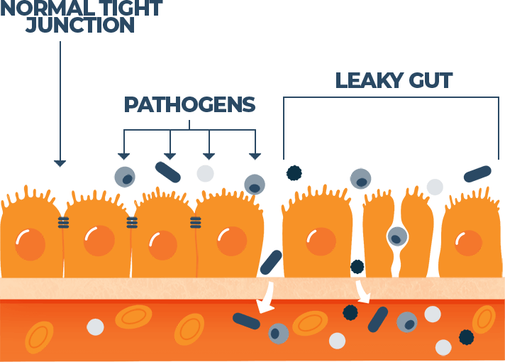 Illustration of a Leaky Gut