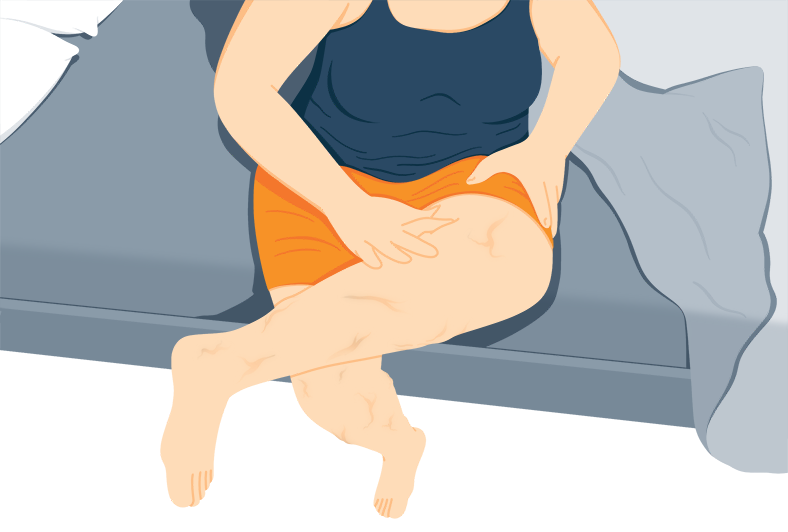Illustration of a Woman Looking at Veins on Her Legs Illustration of a Woman Looking at Veins on Her Legs