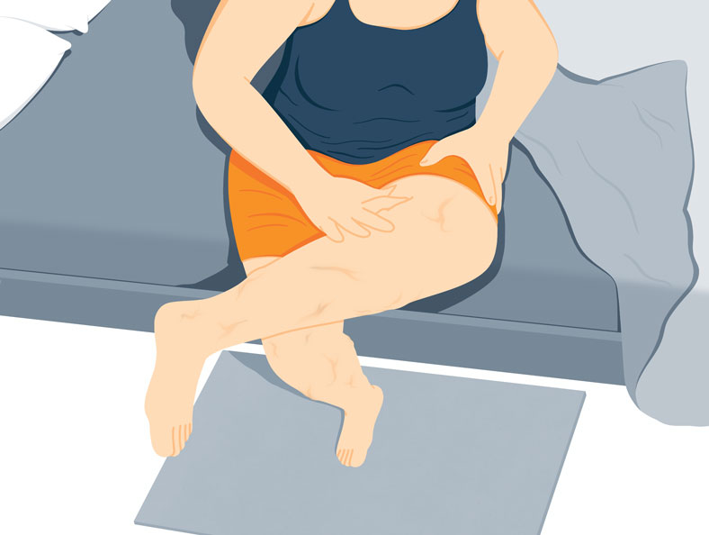 Illustration of a woman showing her legs with deep vein thrombosis