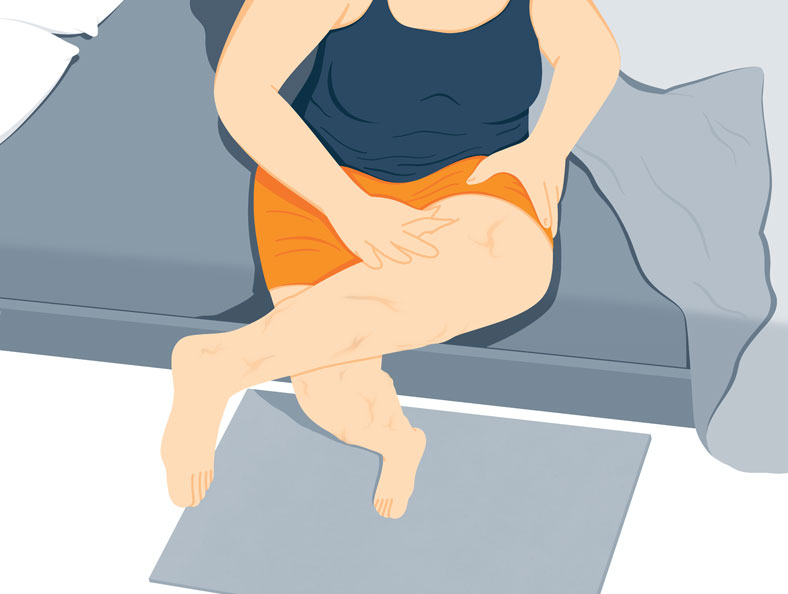Illustration-of-a-woman-showing-her-legs-with-deep-vein-thrombosis Illustration of a woman showing her legs with deep vein thrombosis